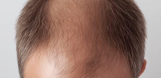 CPT Codes for Alopecia Treatment Billing